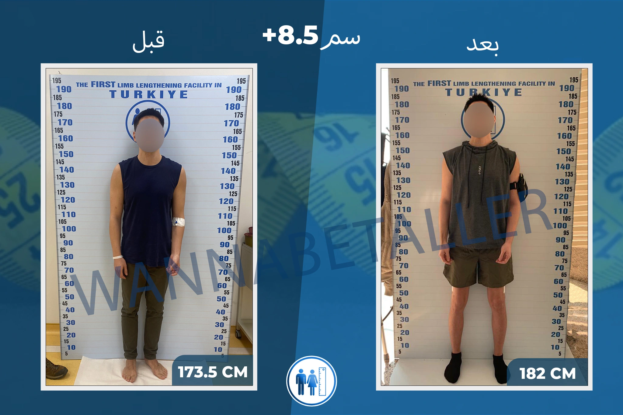 limb-lengthening-surgery-before-after-ar-12