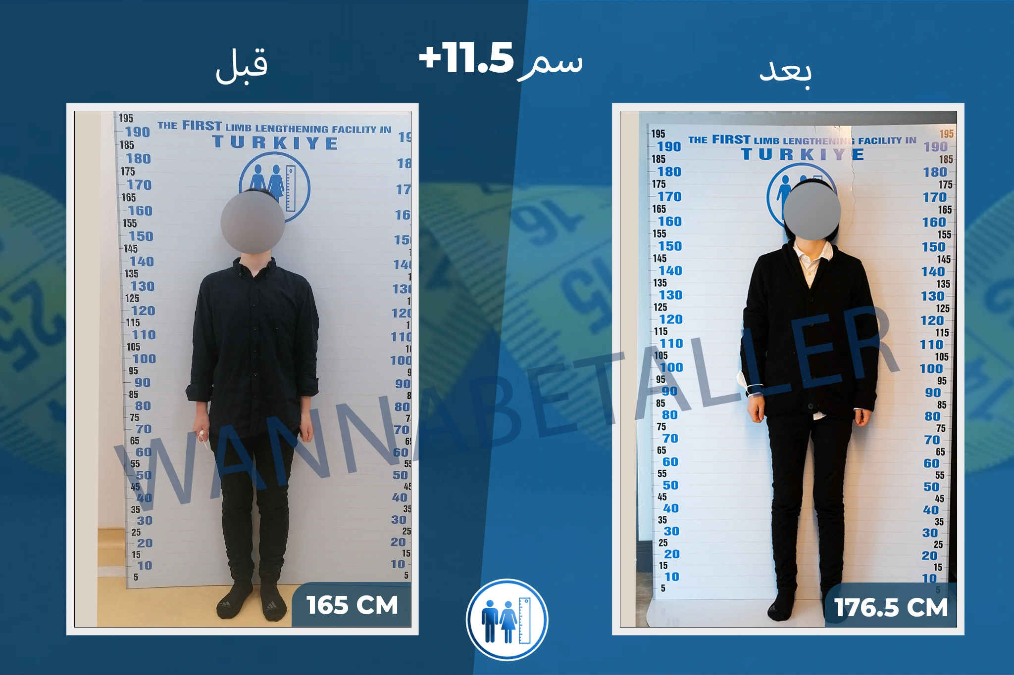 limb-lengthening-surgery-before-after-ar-14