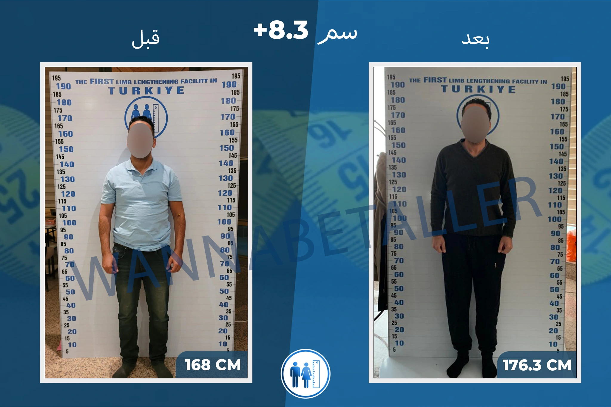 limb-lengthening-surgery-before-after-ar-15