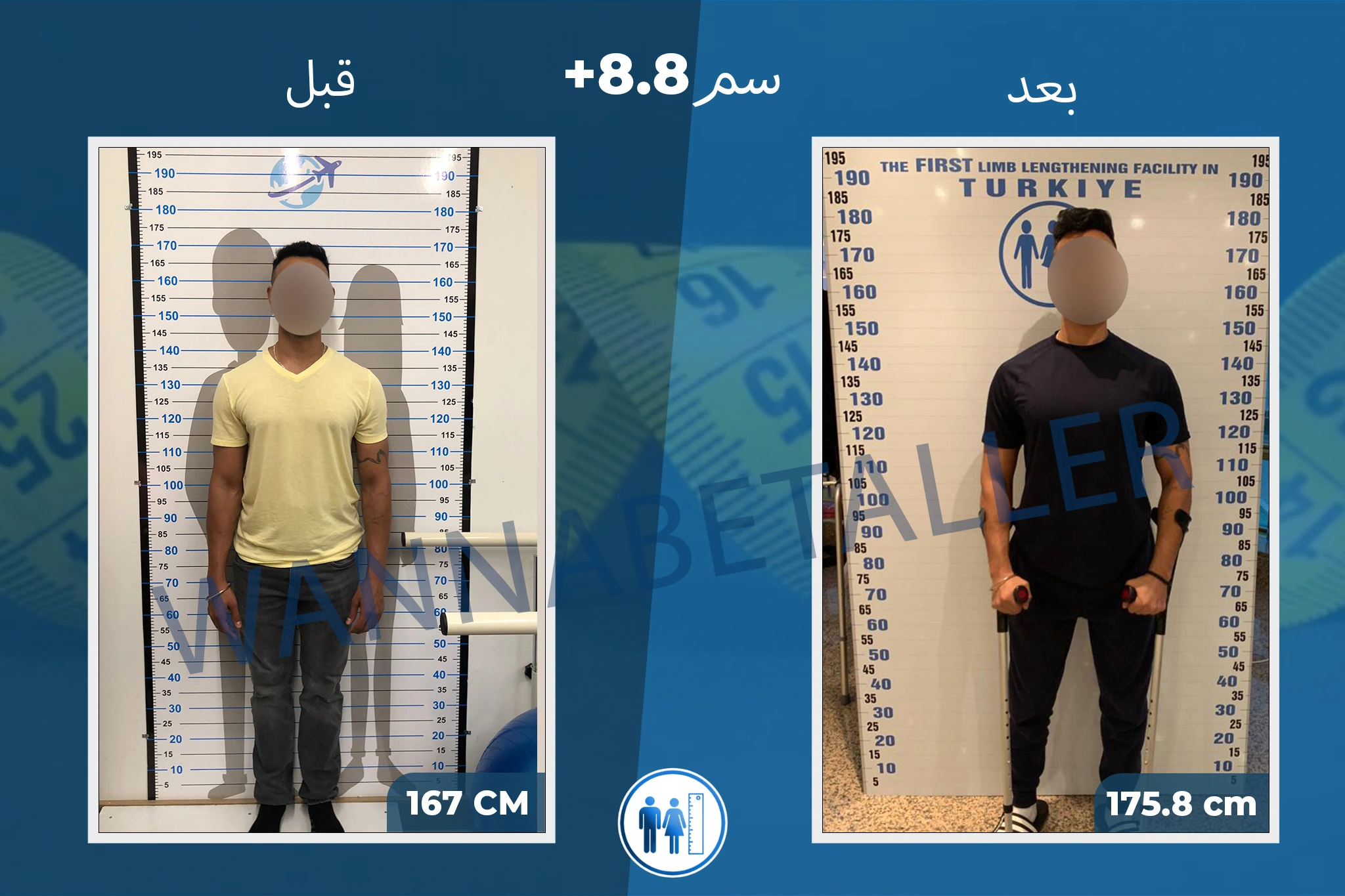 limb-lengthening-surgery-before-after-ar-16