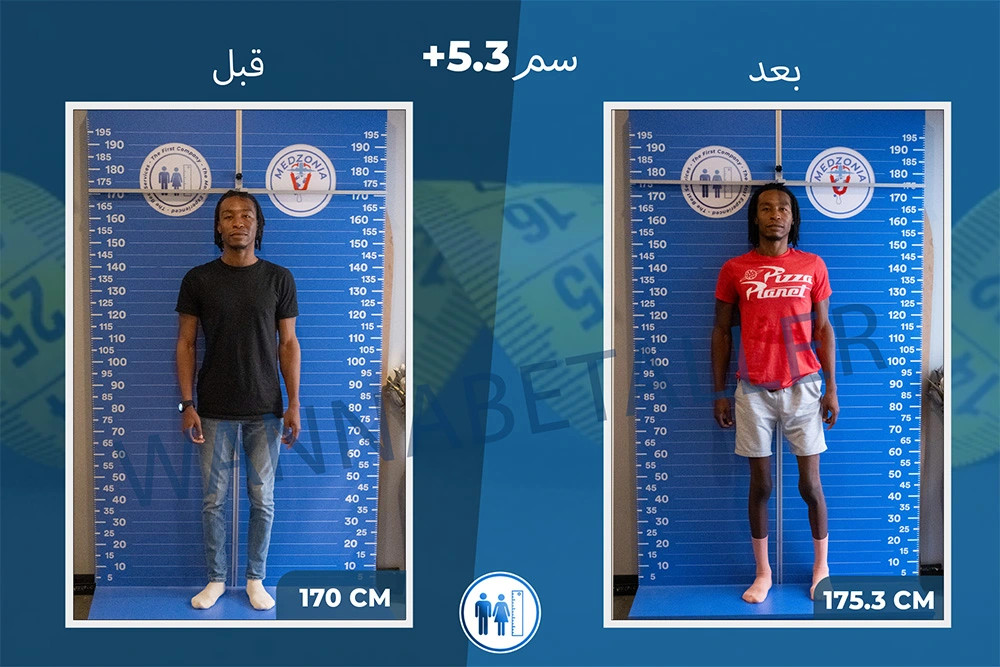 limb-lengthening-surgery-before-after-ar-23