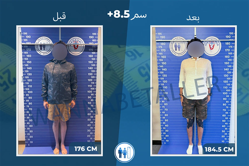 limb-lengthening-surgery-before-after-ar-29