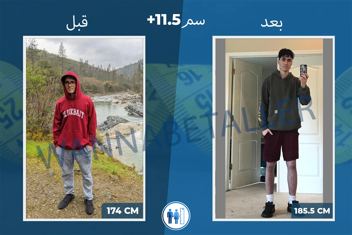 limb-lengthening-surgery-before-after-ar-5