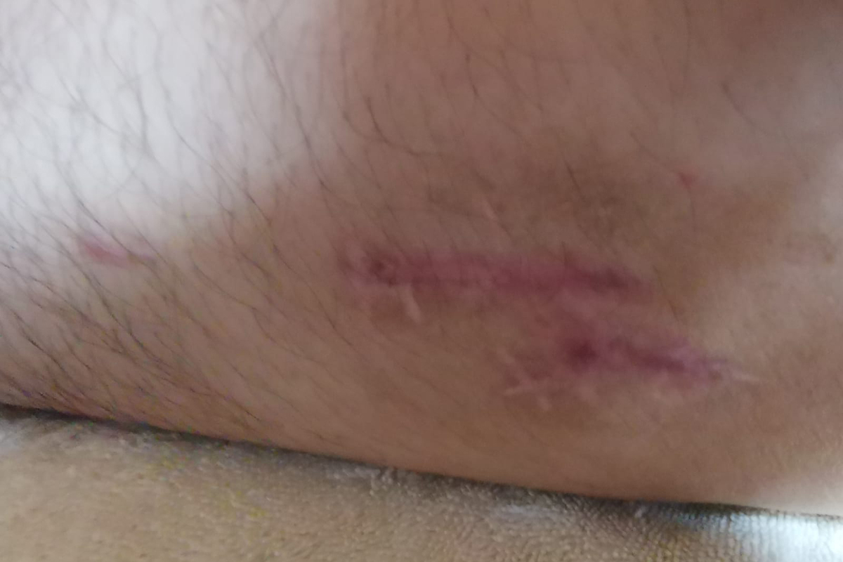 lon-scars-3-5-months-after-device-removal-2