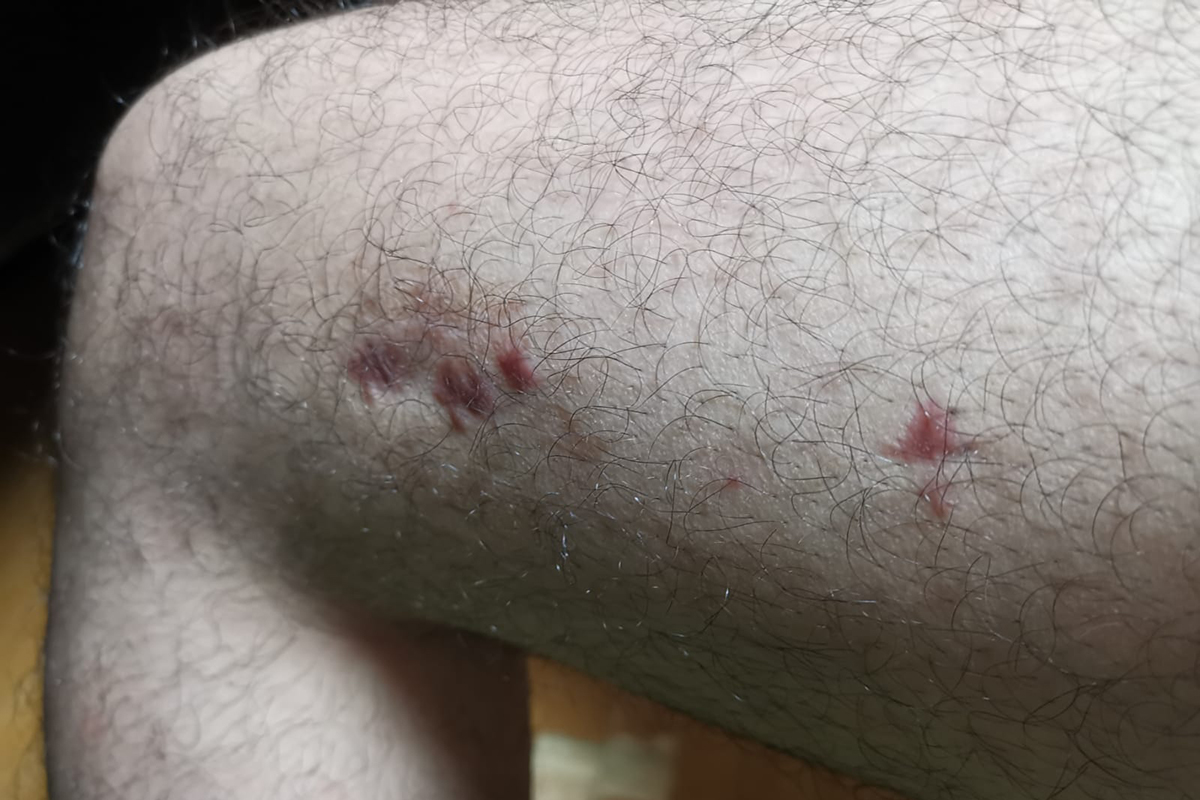 lon-scars-3-5-months-after-device-removal