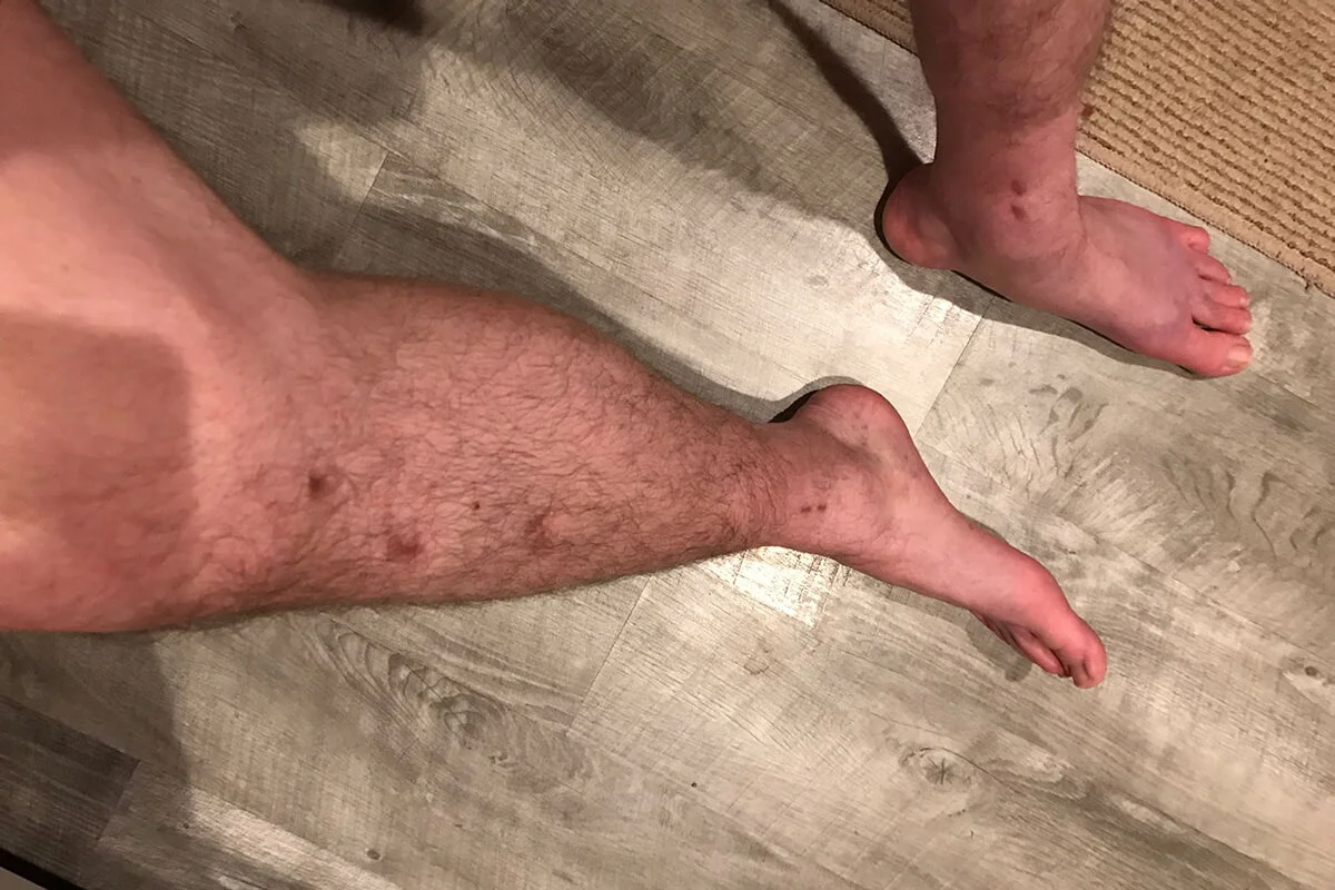 lon-scars-4-5-months-2-after-device-removal-2