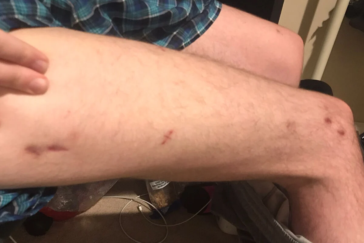 lon-scars-4-5-months-2-after-device-removal