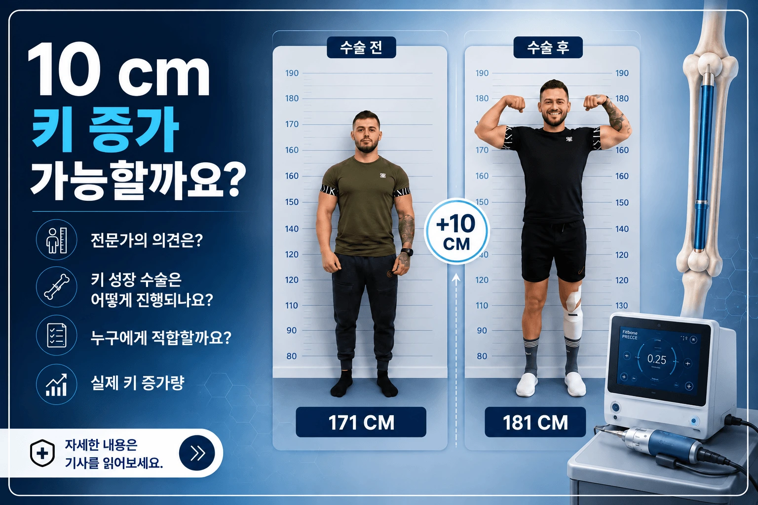 마리우스 그로스의 사지 연장 수술 전후, 171cm에서 181cm로