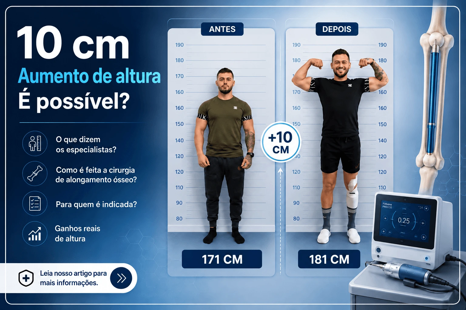 Marius Gros antes e depois da cirurgia de alongamento dos membros, de 171 cm para 181 cm