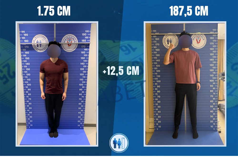 Max before and after: from 175 cm to 187.5 cm, +12.5 cm