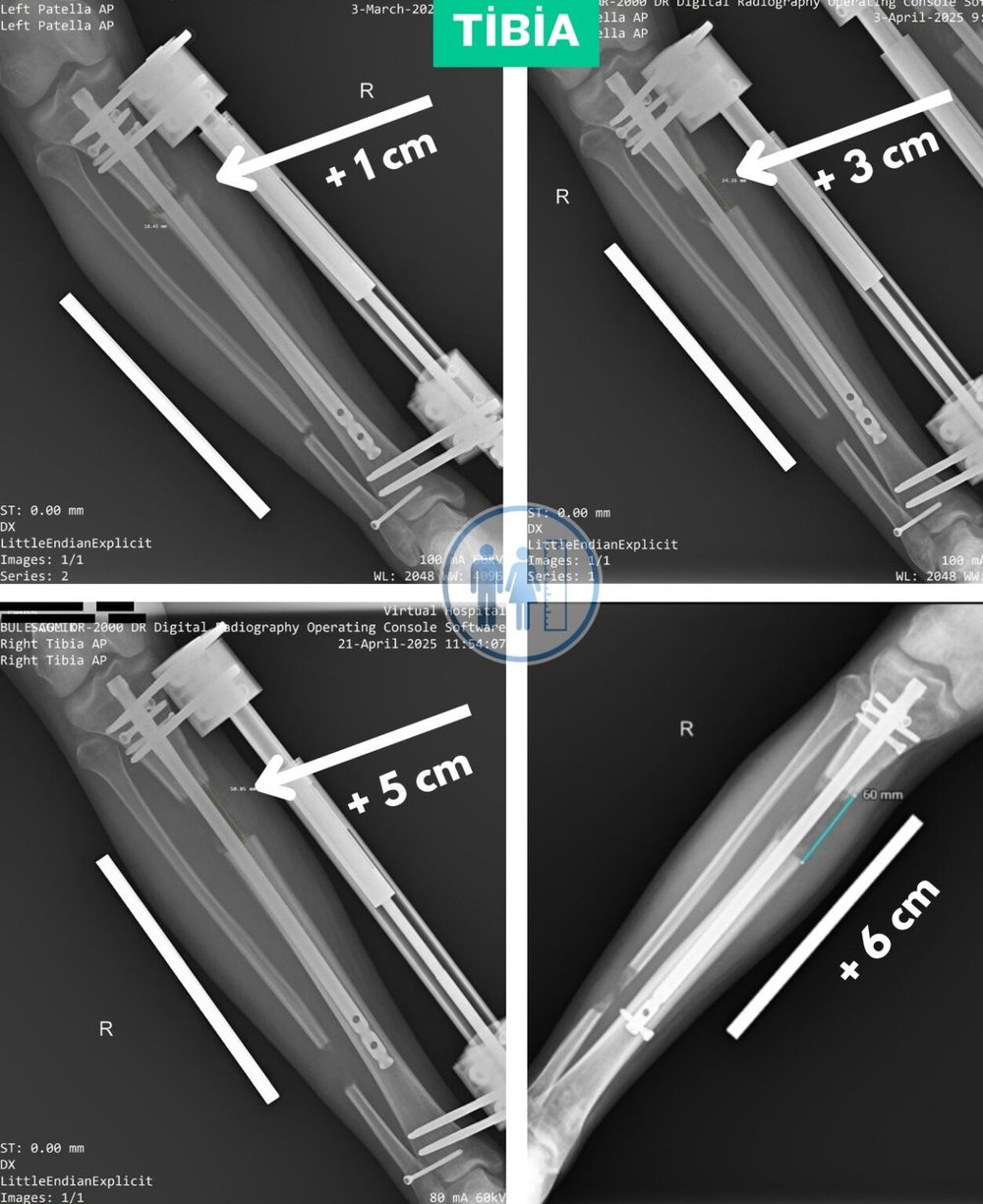 Tibia Control X-Rays: +1 Cm, +3 Cm, +5 Cm And The Final +6 Cm