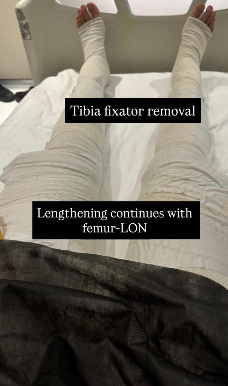 Tibia fixator removal