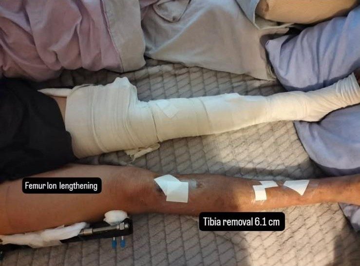 Femur LON lengthening and tibia removal