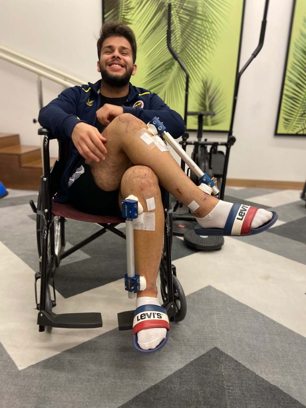 Smiling patient in a wheelchair with LON fixators