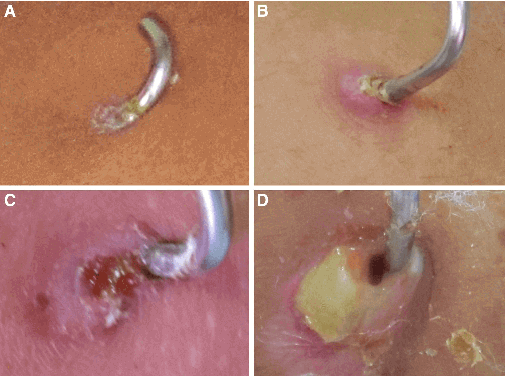 pin tract infection risk for osteomyelitis