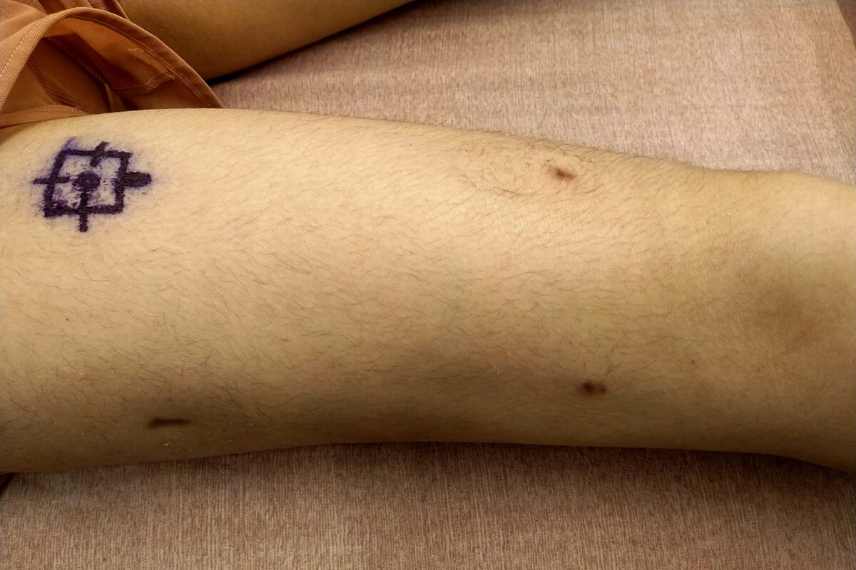 precice-scars-after-2-months