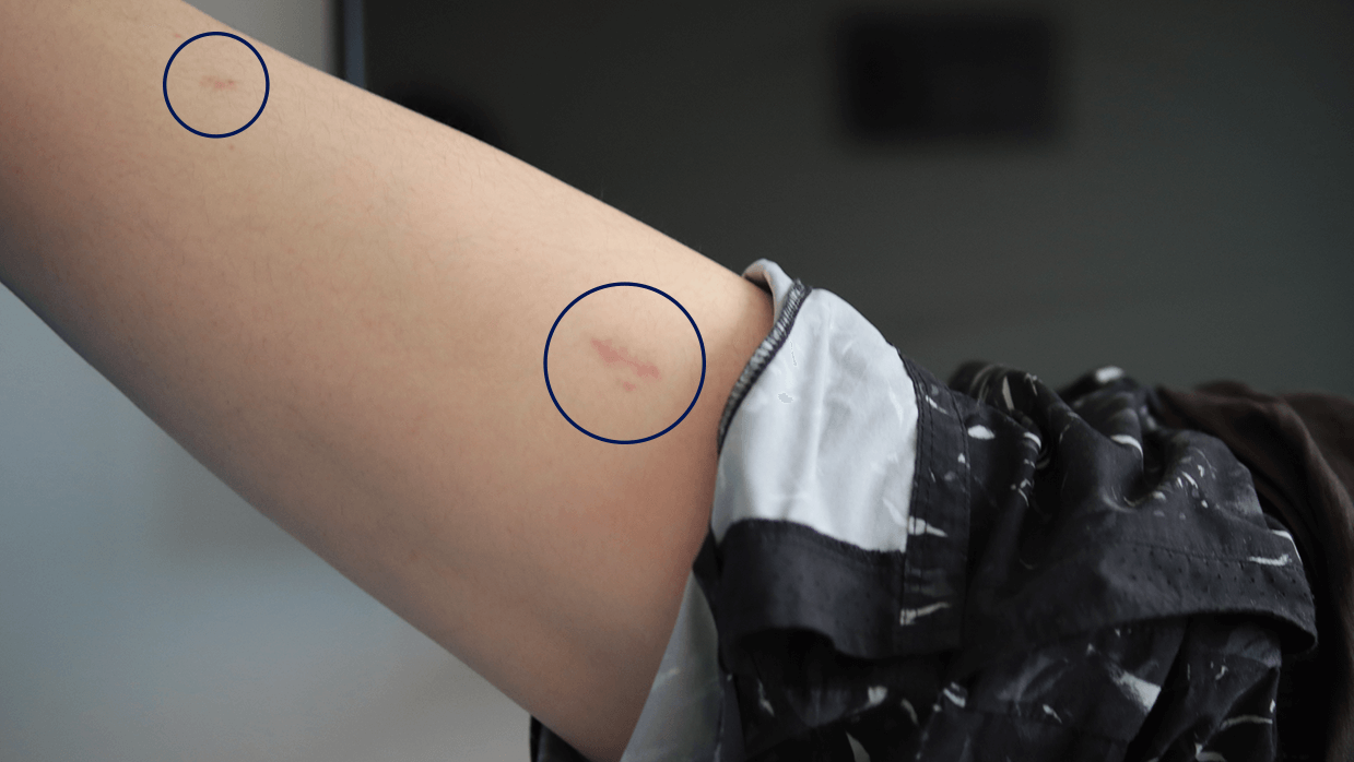 Precice 2 incisions