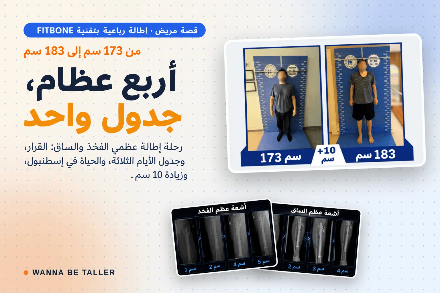 إطالة الأطراف الأربعة باستخدام Fitbone: رحلة زيادة 10 سم