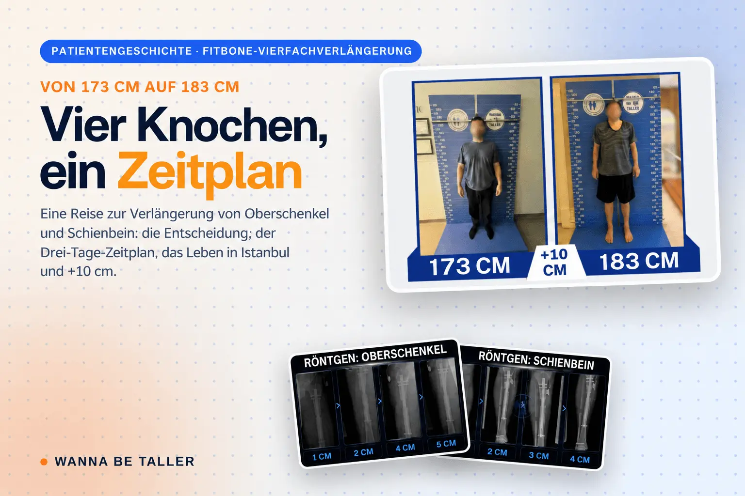 Quadrilaterale Verlängerung mit Fitbone: Ein Weg zu +10 cm