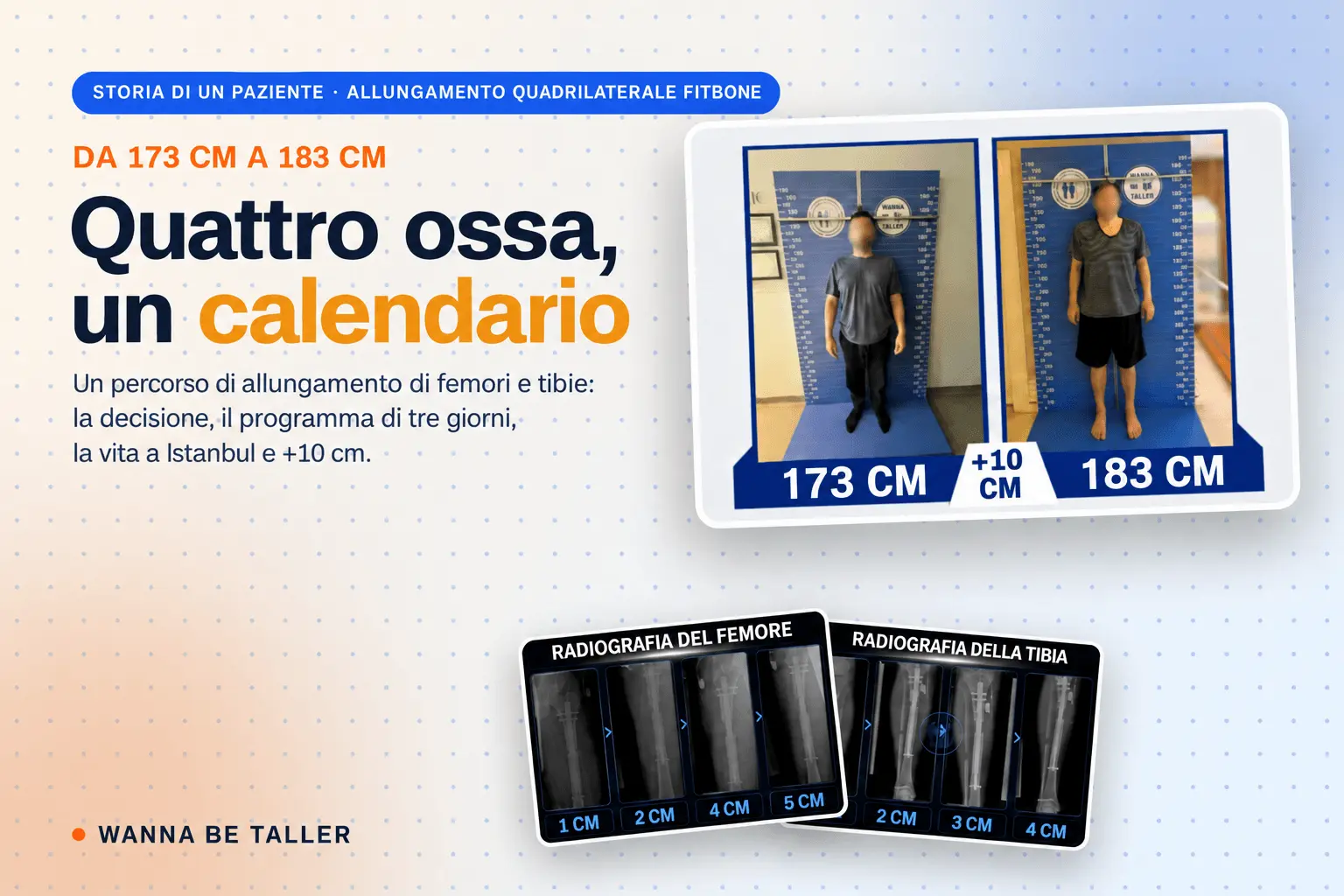 Alongamento quadrilateral com Fitbone: uma jornada de +10 cm