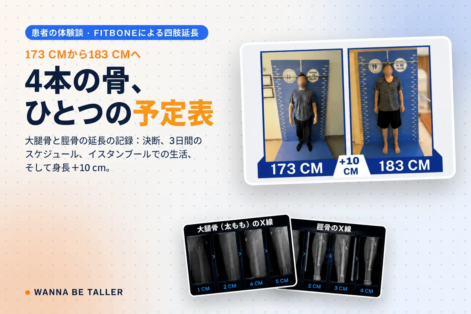 Fitboneによる両脚の大腿骨・脛骨延長：＋10 cmへの歩み