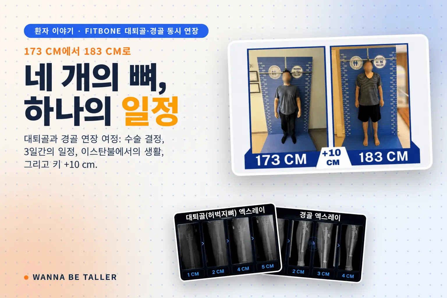 Fitbone을 이용한 양측 대퇴골·경골 연장: 10cm의 여정