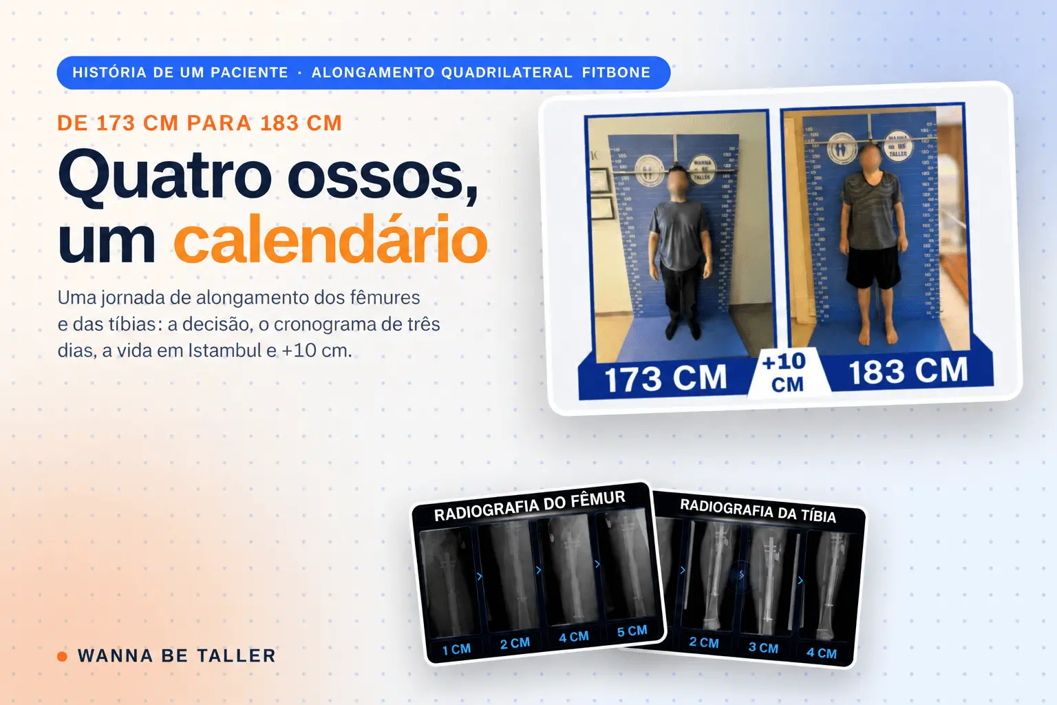 Alongamento quadrilateral com Fitbone: uma jornada de +10 cm