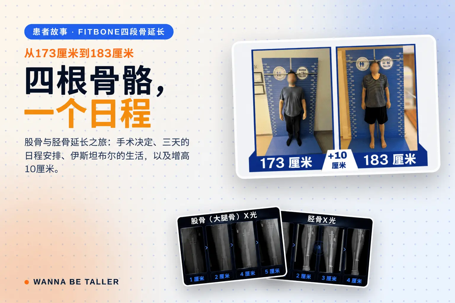 Fitbone四骨段延长：增高10厘米的历程