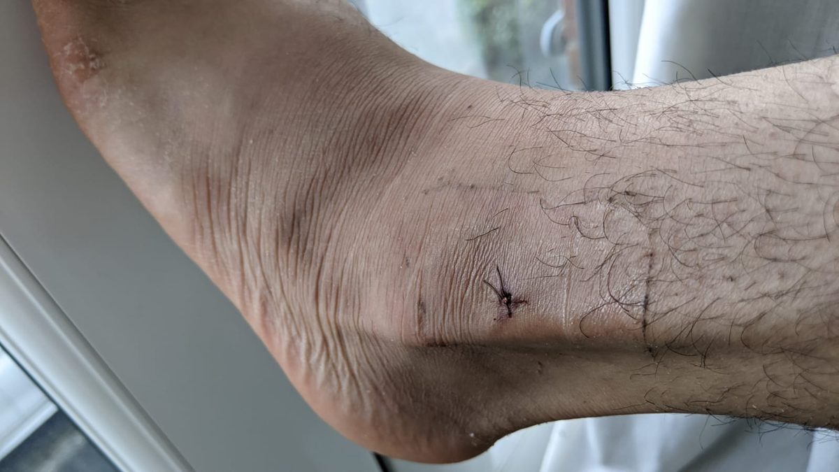 1 month after fixator removal · LON tibia