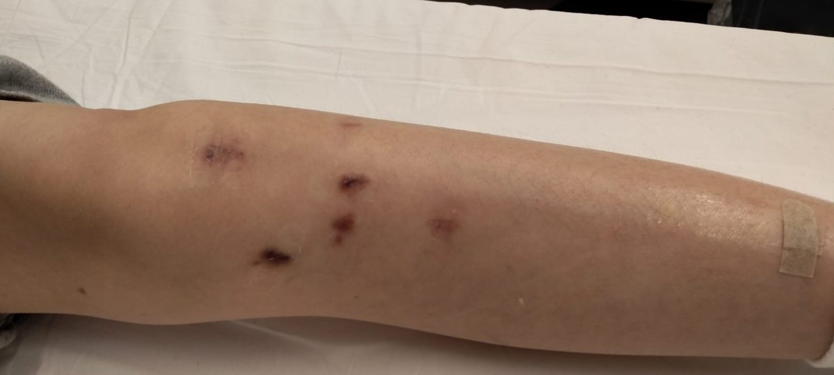 2 months after fixator removal