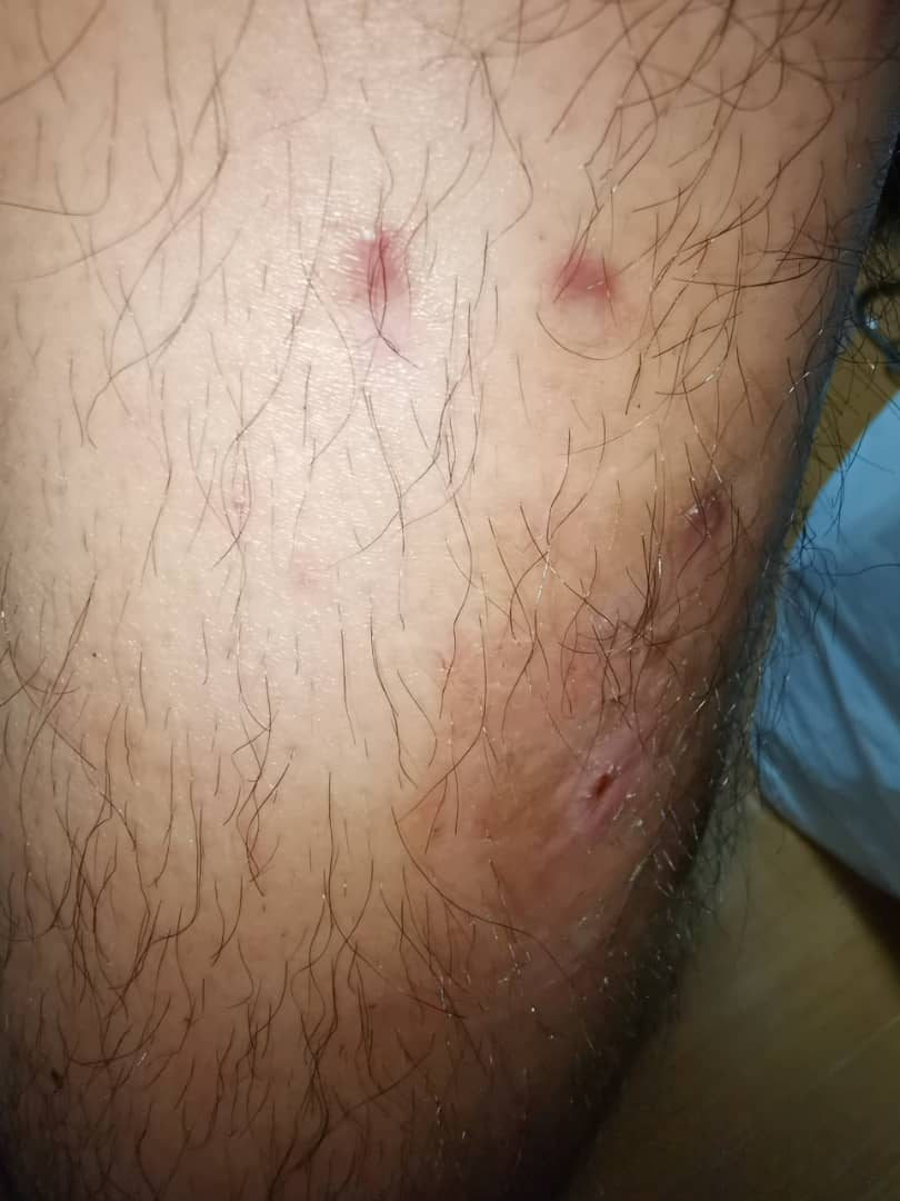 2.5 months after fixator removal