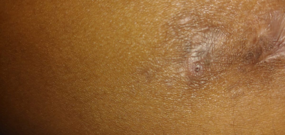 3 months after fixator removal