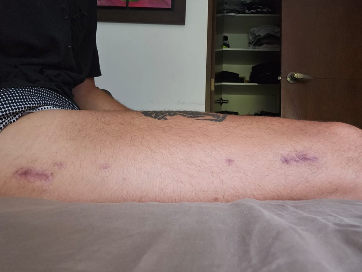 3 months after fixator removal