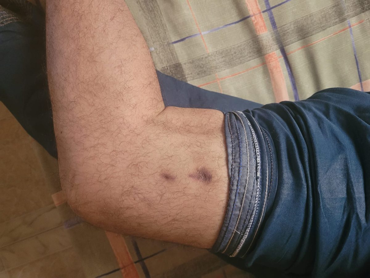 3.5 months after fixator removal