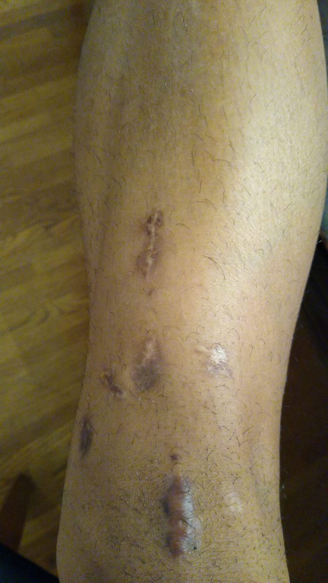 3.5 months after fixator removal