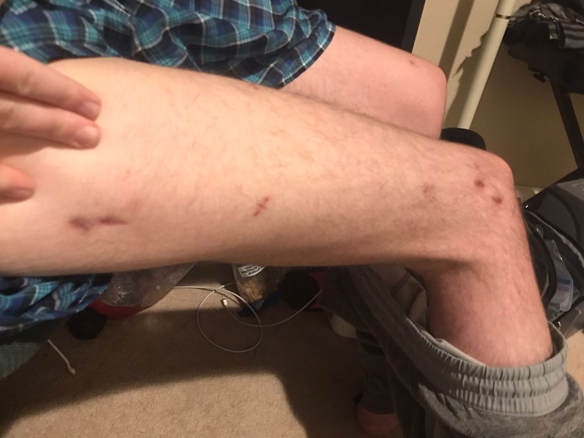 4–5 months after fixator removal