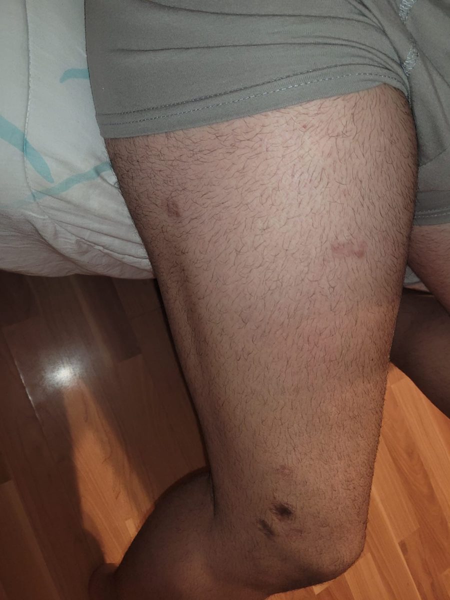6 months after fixator removal