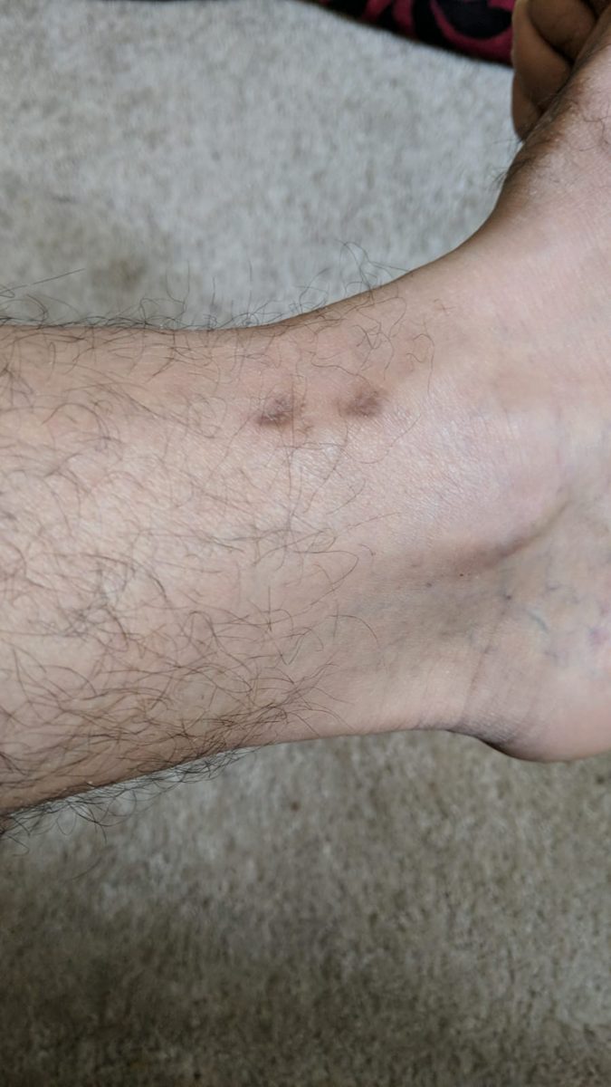 7 months after fixator removal