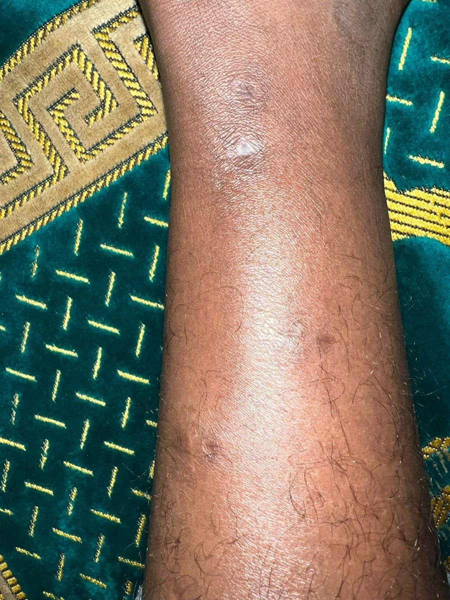 8 months after surgery