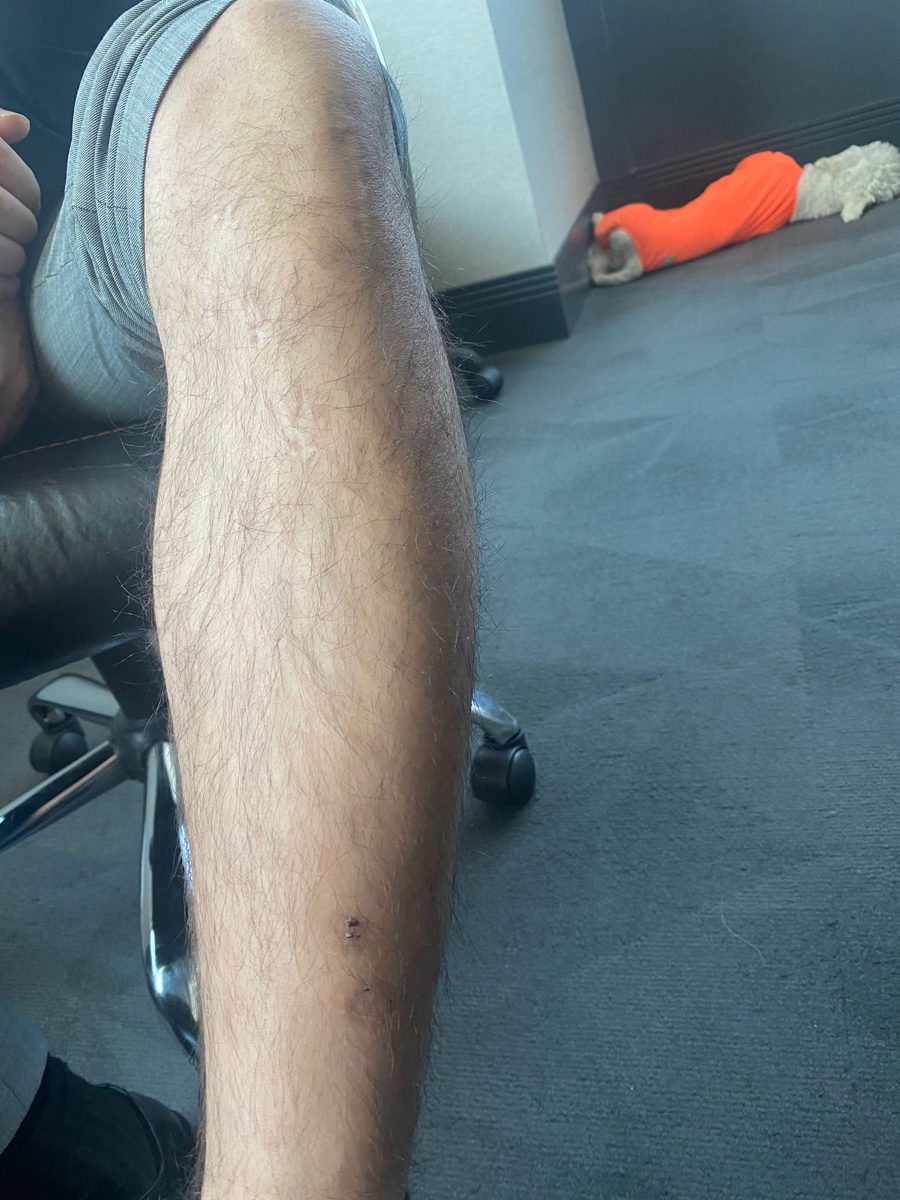 1 year LON tibia