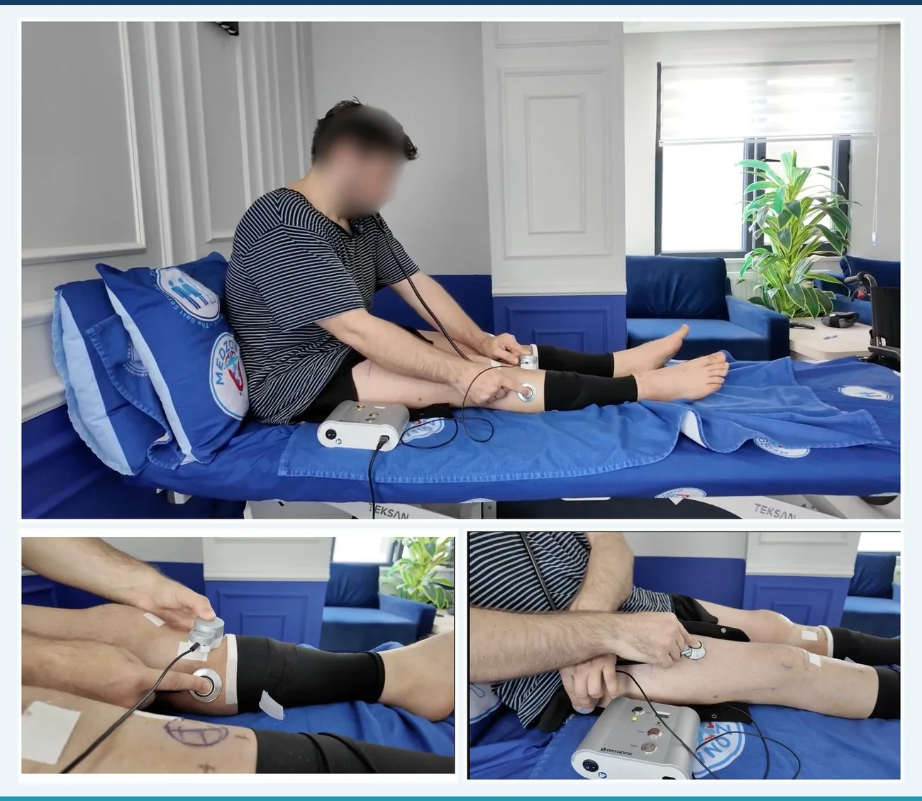 Vitali使用外部控制器进行FITBONE延长操作