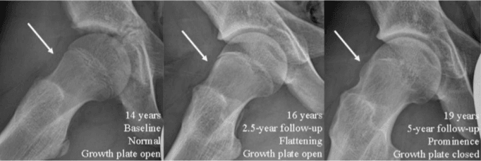 Growth plates