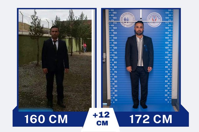 İbrahim Alğan before and after two limb lengthening surgeries: 160 cm to 172 cm, +12 cm